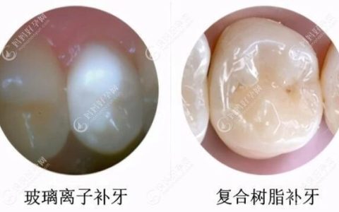 补哪种牙齿好？