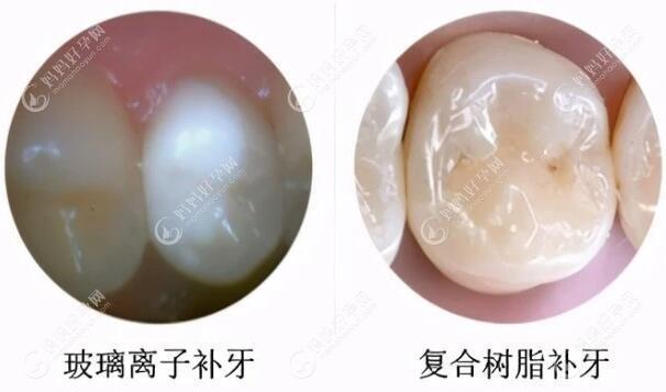 补哪种牙齿好？