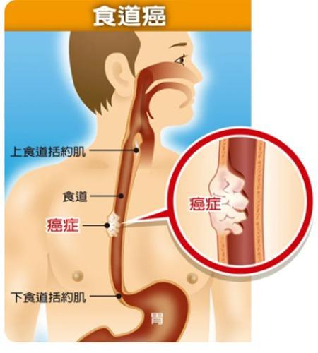 感觉食道一直卡着东西？可能是这些原因！
